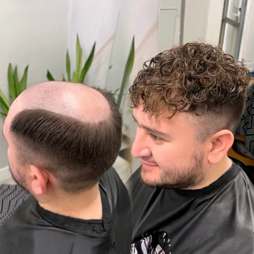 Hair Replacement Hair Systems Men's Hair Units in Arvada Colorado before and after 3