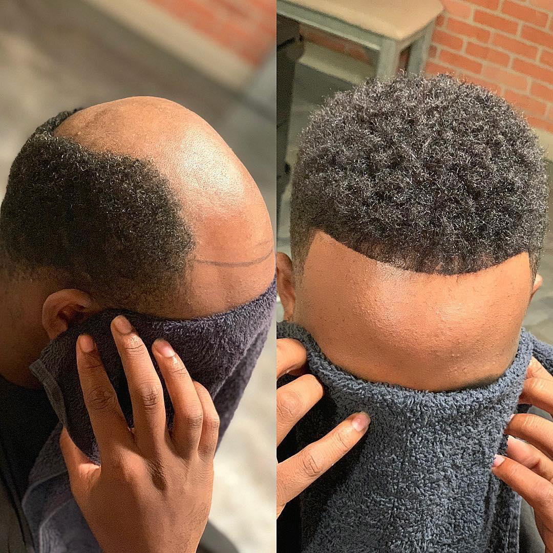 Hair Replacement Hair Systems Men's Hair Units in Arvada Colorado before and after 4